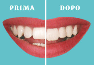 faccette-dentali-osimo